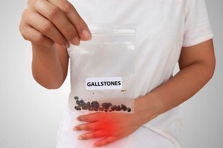 obat batu empedu