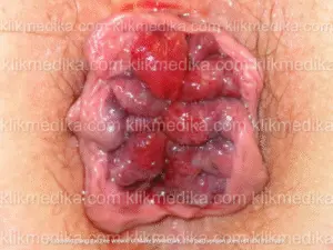 ambeien hemoroid wasir