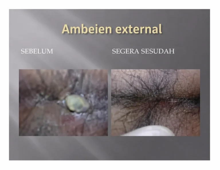 obat ambeien