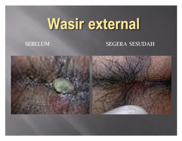 obat wasir ambefree