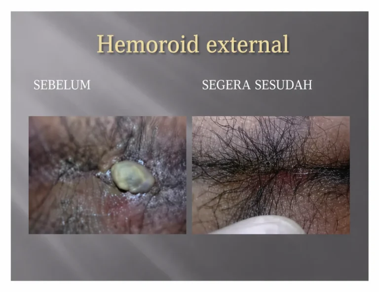 obat hemoroid
