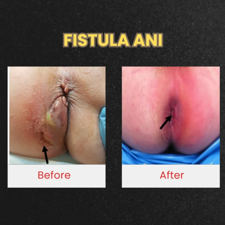 FISTULA ANI