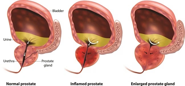 obat prostat