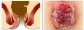 ambeien hemoroid wasir
