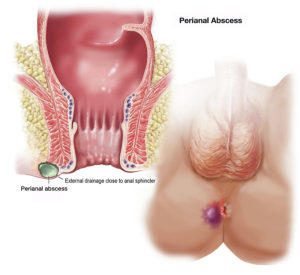 obat fistula ani ambefree